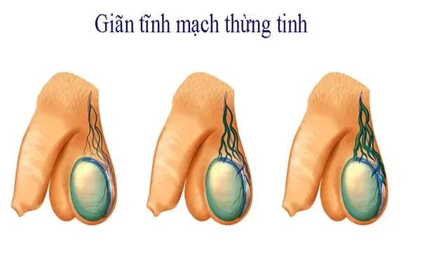 Tìm hiểu chung Giãn tĩnh mạch thừng tinh