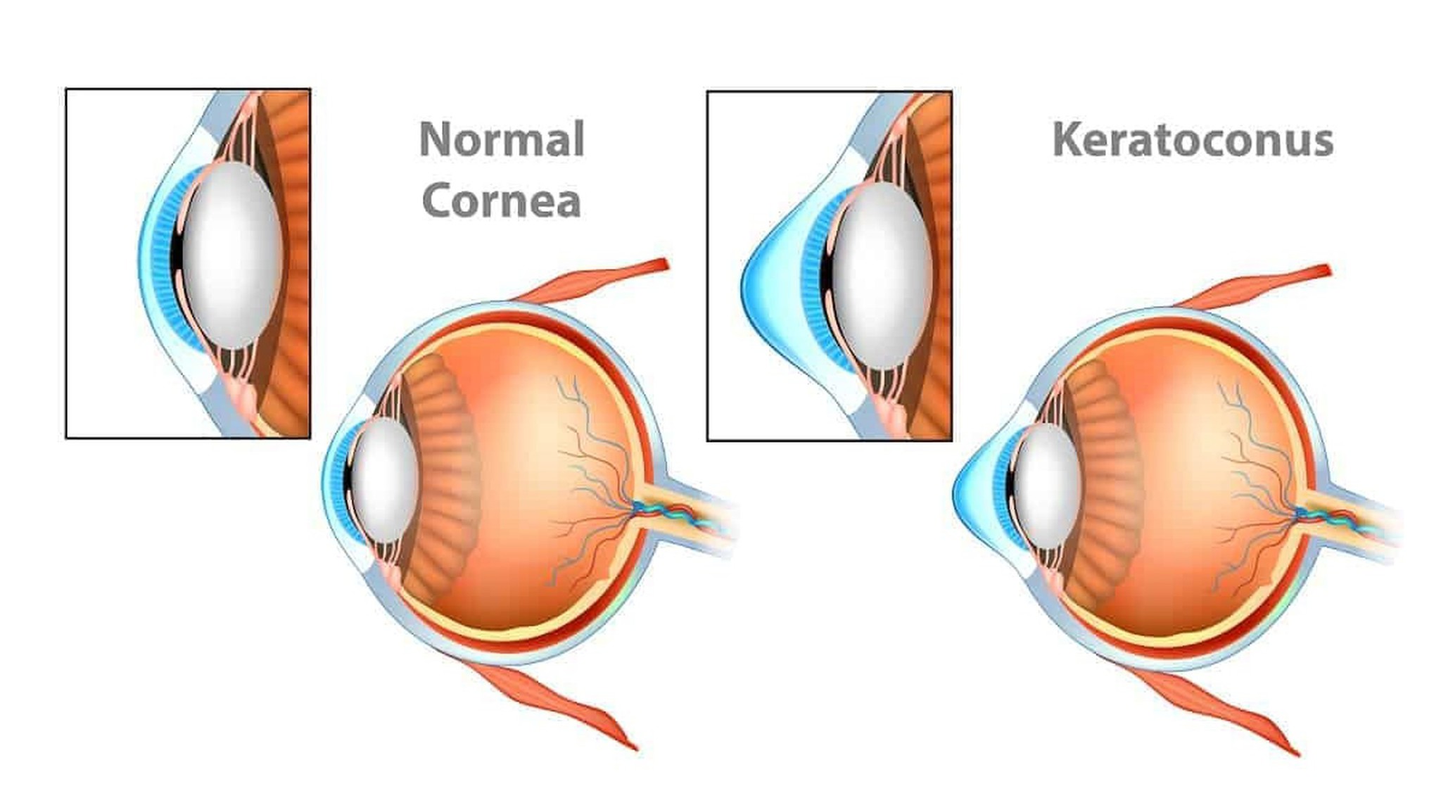Giác mạc hình chóp là gì? Những vấn đề cần biết về giác mạc hình chóp