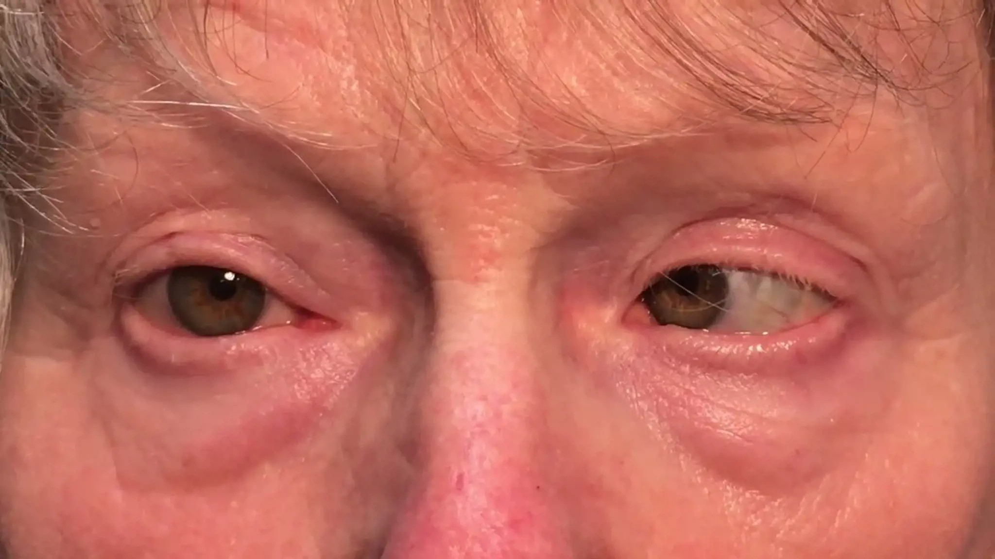 Liệt dây thần kinh số VI: Nguyên nhân, triệu chứng và điều trị