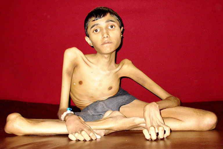 Tìm hiểu chung loạn dưỡng cơ duchenne