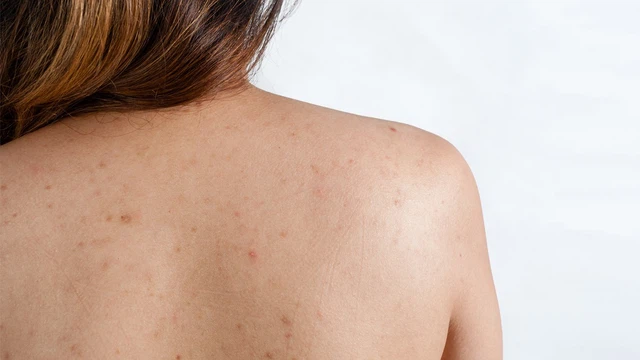 Mụn bọc là gì? Những điều bạn cần biết về mụn bọc