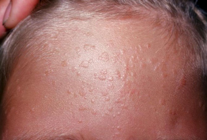 Mụn cóc phẳng là gì?