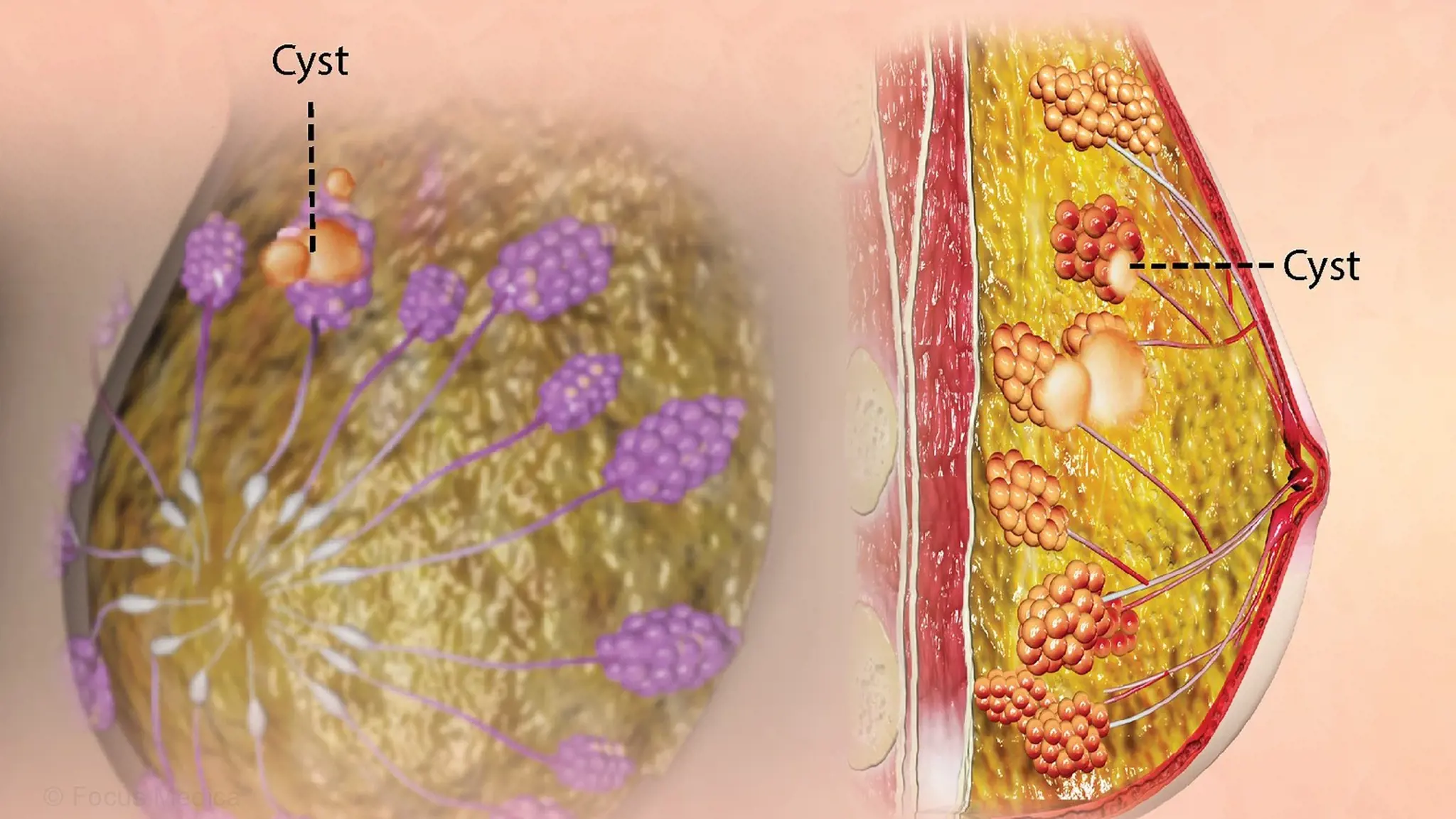 Nang vú: Nguyên nhân, triệu chứng và cách điều trị