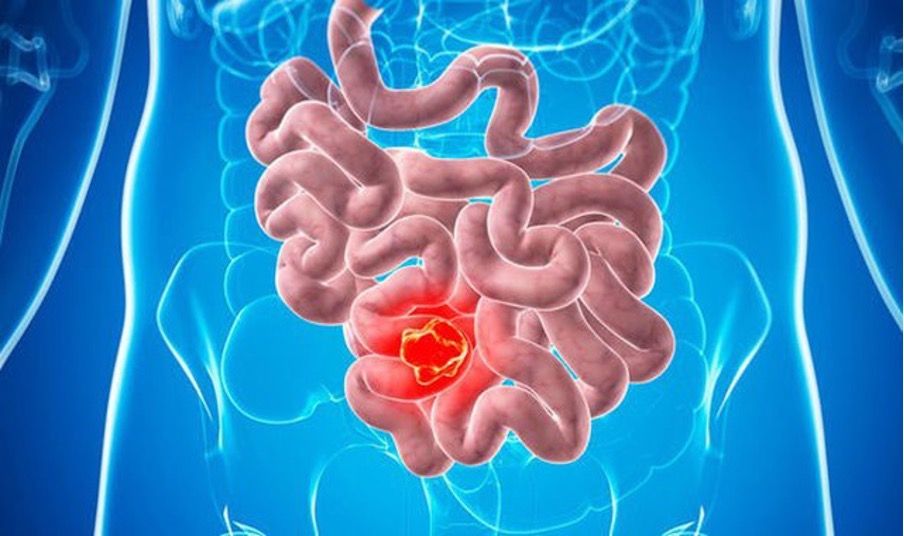 Tìm hiểu về: Ung Thư Ruột ?