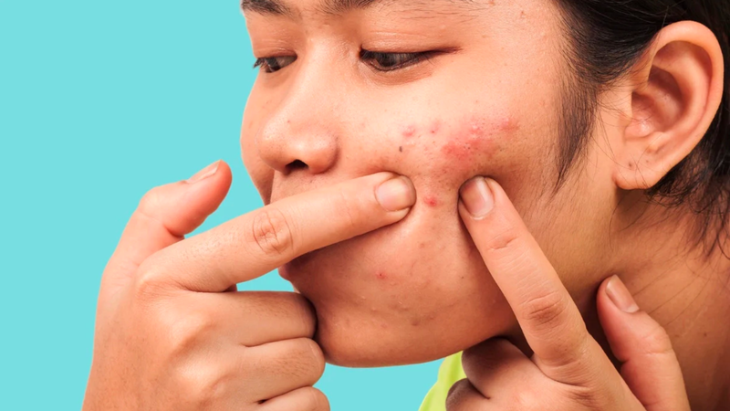 Sẹo rỗ là gì? Nguyên nhân, triệu chứng và cách điều trị