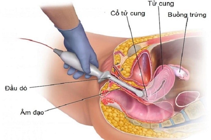 Lạc nội mạc ở âm hộ là gì?