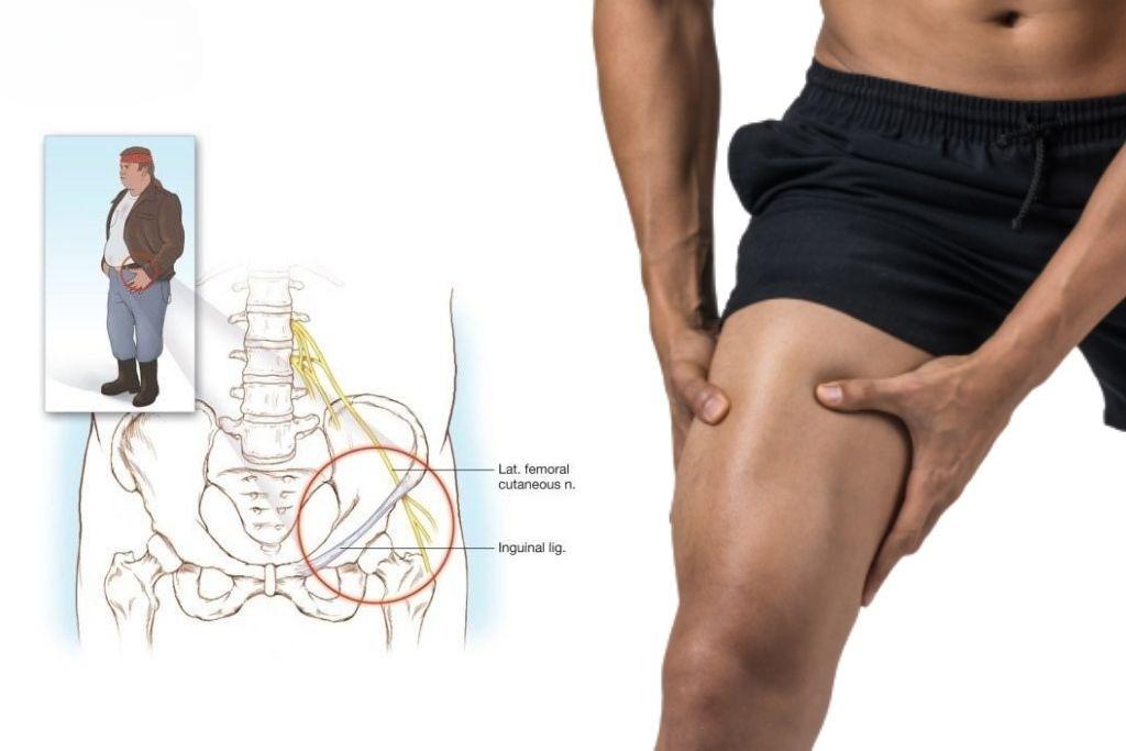Đau đùi dị cảm là gì? Những điều cần biết về tình trạng đau đùi dị cảm