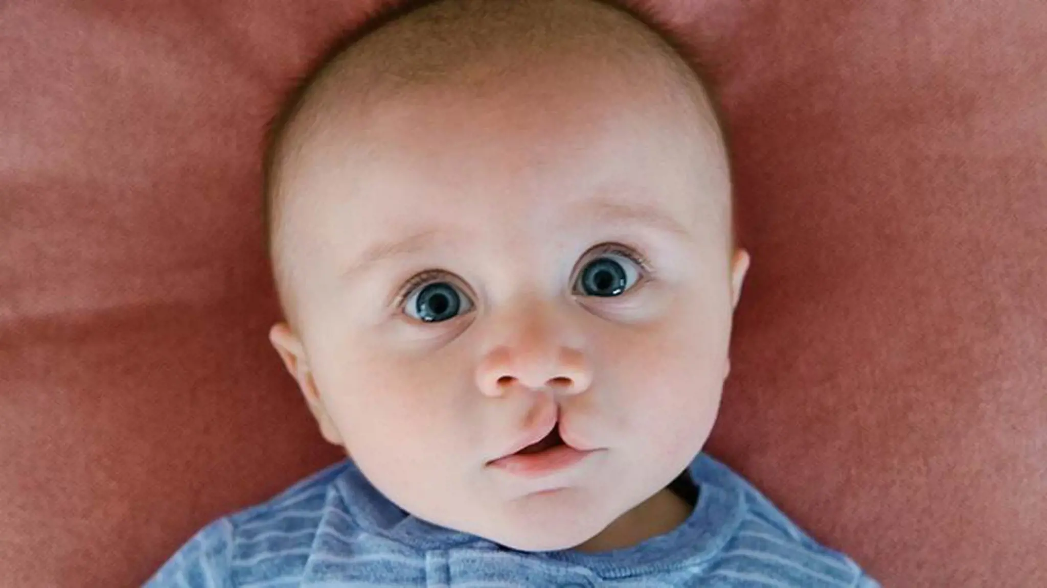 Sứt môi (hở hàm ếch): Nguyên nhân, triệu chứng và cách điều trị