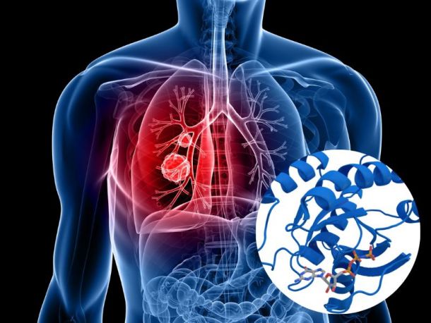 Thuốc chữa ung thư phổi gồm những loại nào?