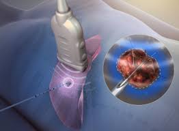 Thông tin cần biết về đốt sóng cao tần điều trị ung thư gan