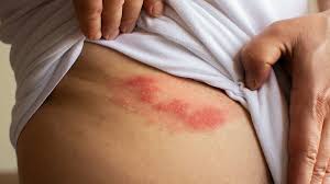 Bệnh viện nào chữa zona thần kinh tốt nhất?