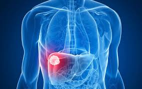 Ung thư gan thứ phát – Nỗi sợ của bệnh nhân ung thư