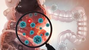 Ung thư đại trực tràng giai đoạn 2: Dấu hiệu và cách điều trị