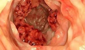 Ung thư đại tràng giai đoạn cuối: Nhận biết và điều trị phù hợp