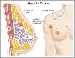 Dấu hiệu nhận biết và tỷ lệ sống sốt của bệnh nhân ung thư vú giai đoạn 2