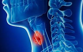 Ung thư thanh quản, nguyên nhân và cách điều trị.