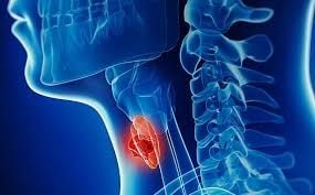 Ung thư thanh quản, nguyên nhân và cách điều trị.