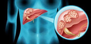 Ung thư gan di căn có chữa được không? Những điều cần biết