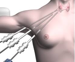 Mổ ung thư tuyến giáp: Nên mổ mở hay mổ nội soi?