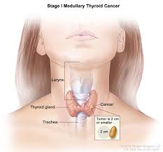 Chi tiết từng giai đoạn ung thư tuyến giáp