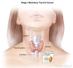 Chi tiết từng giai đoạn ung thư tuyến giáp