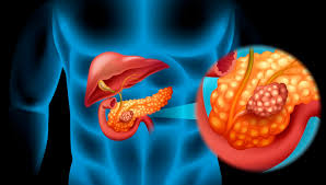 Những điều cần biết về Ung thư tụy