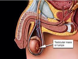 Ung thư tinh hoàn, nguyên nhân và cách điều trị bệnh