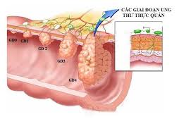 Ung thư thực quản giai đoạn 2: Dấu hiệu và cách điều trị