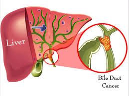 Tổng quan về ung thư đường mật từ A đến Z