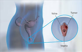 Ung thư âm hộ: Nguyên nhân, dấu hiệu, chẩn đoán và điều trị
