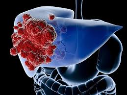 U gan đa ổ là gì? Có phải ung thư không? Tất cả những điều cần biết