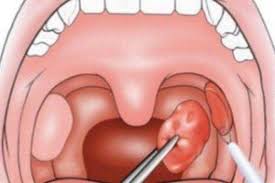 1001 điều cần biết về ung thư amidan