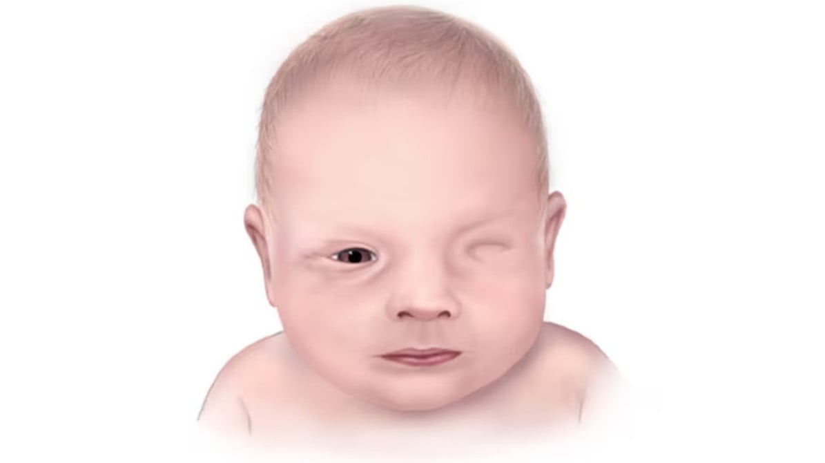 Tật không nhãn cầu là bệnh gì? Những điều cần lưu ý