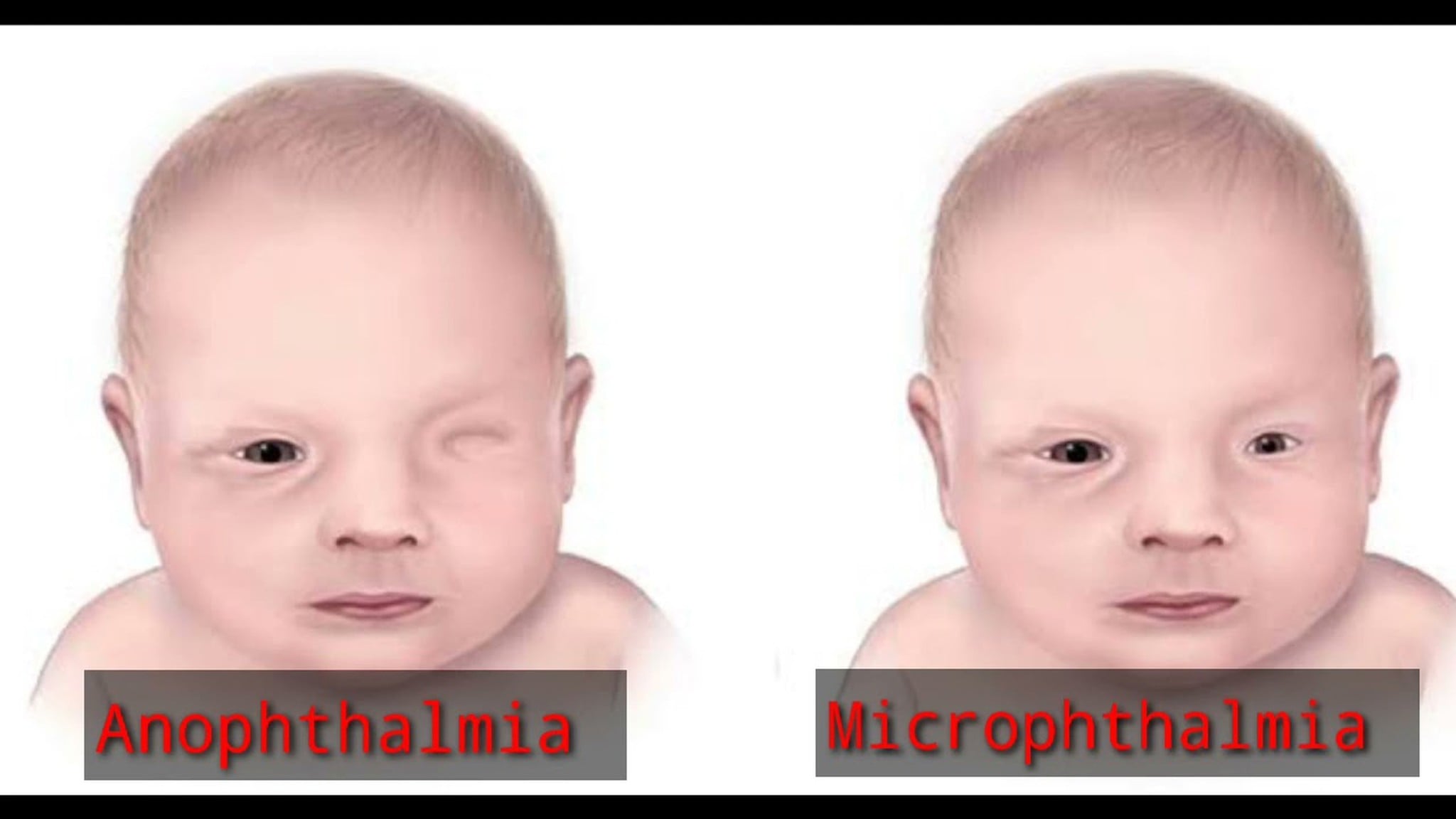 Tật mắt nhỏ là gì? Những điều cần biết