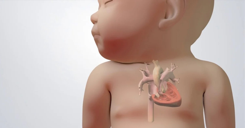 Tứ chứng Fallot là gì? Dấu hiệu nhận biết và cách điều trị