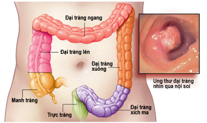 Ung thư manh tràng ? Nguyên nhân, dấu hiệu và cách phòng tránh