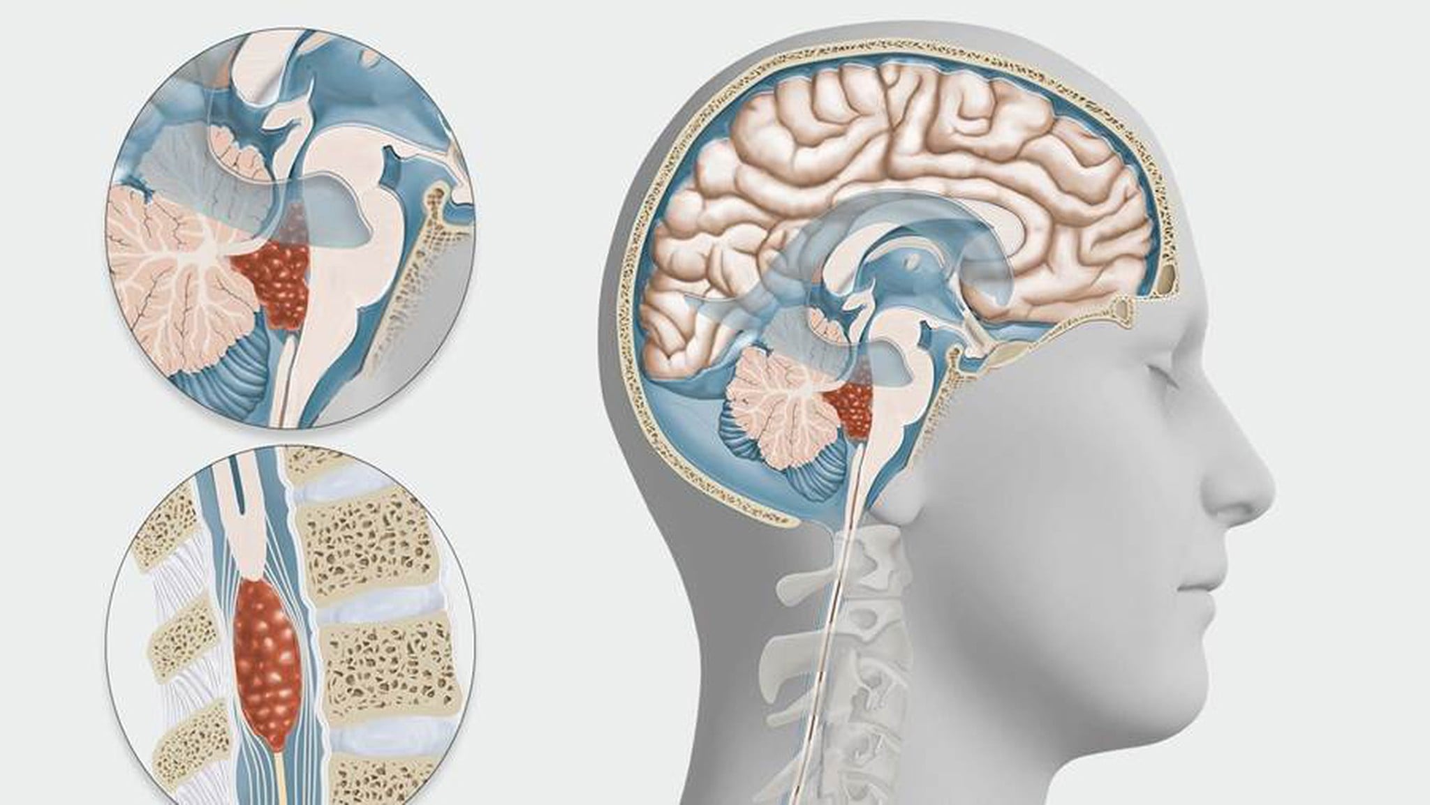 U màng ống nội tủy là gì? Nguyên nhân, triệu chứng và cách điều trị