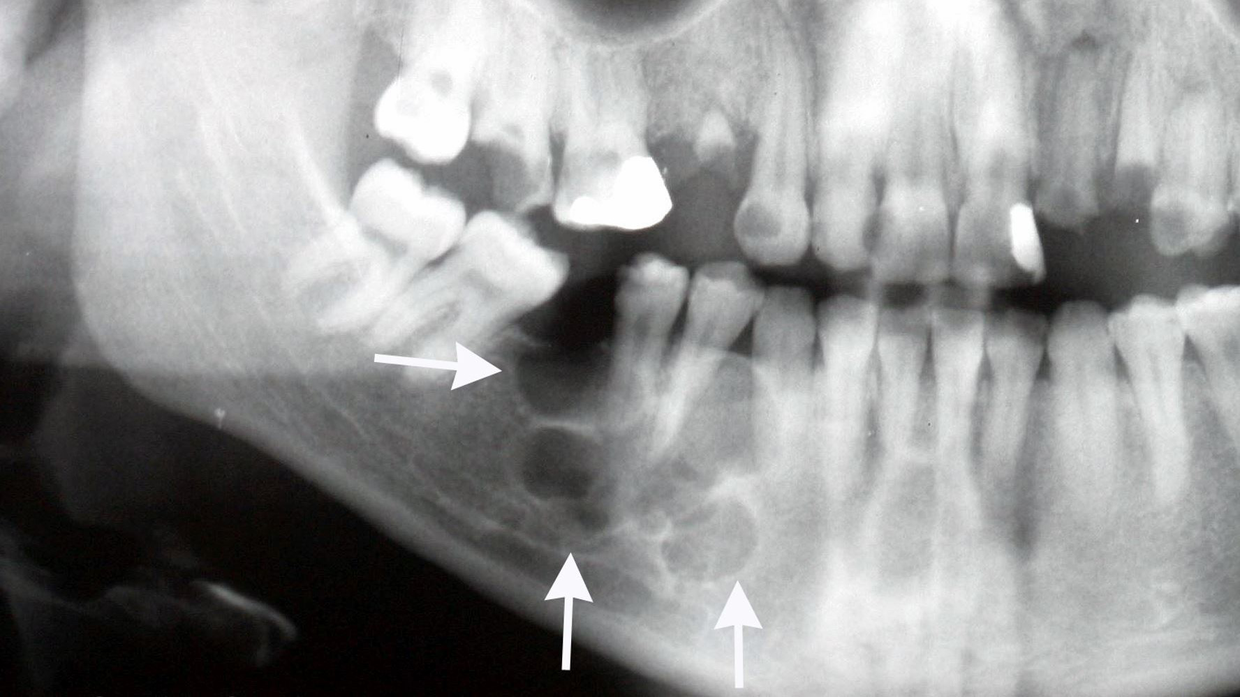 U men xương hàm: Bệnh ung thư hiếm gặp nhưng khó phát hiện