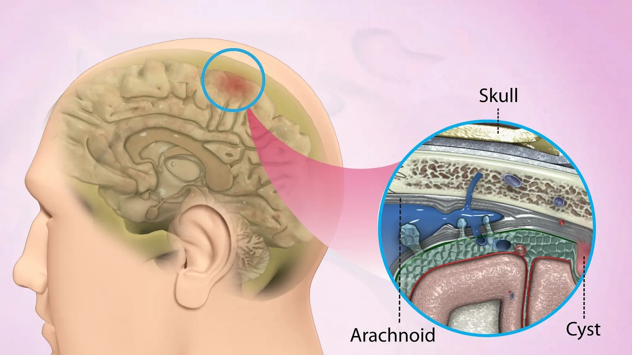 U nang màng nhện: Hiểu hơn về triệu chứng, nguyên nhân và phương pháp điều trị
