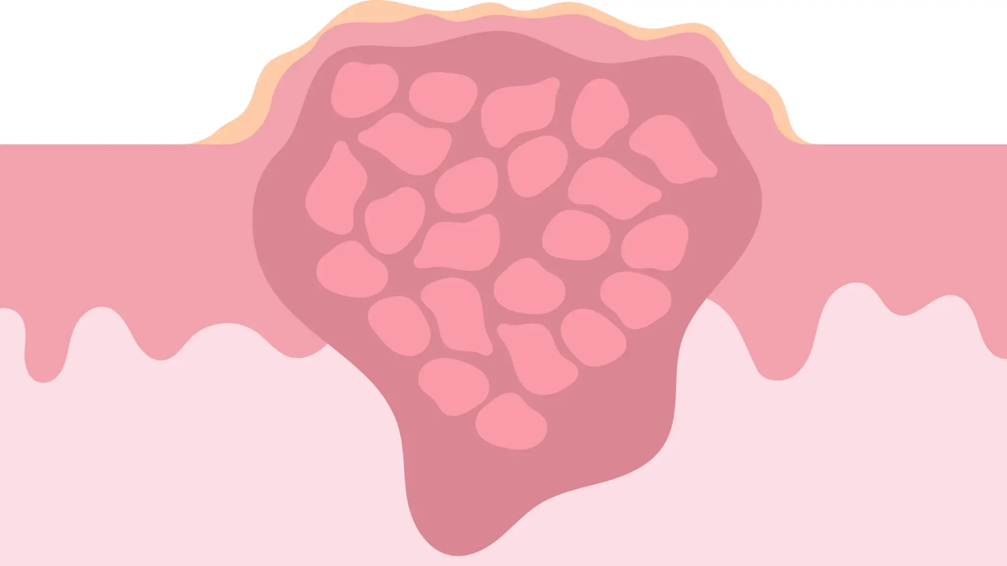 U nguyên bào xơ cơ viêm là gì? Triệu chứng, nguyên nhân, chẩn đoán và điều trị