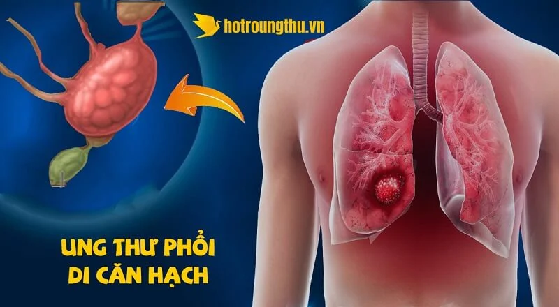 Bạn đã biết: Ung thư phổi di căn hạch?