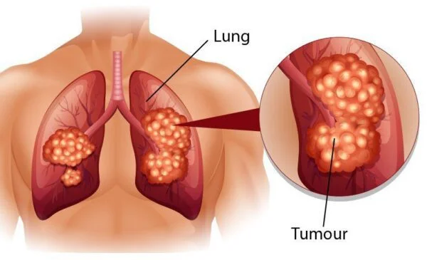Ung thư phổi giai đoạn 3 và những điều cần biết.