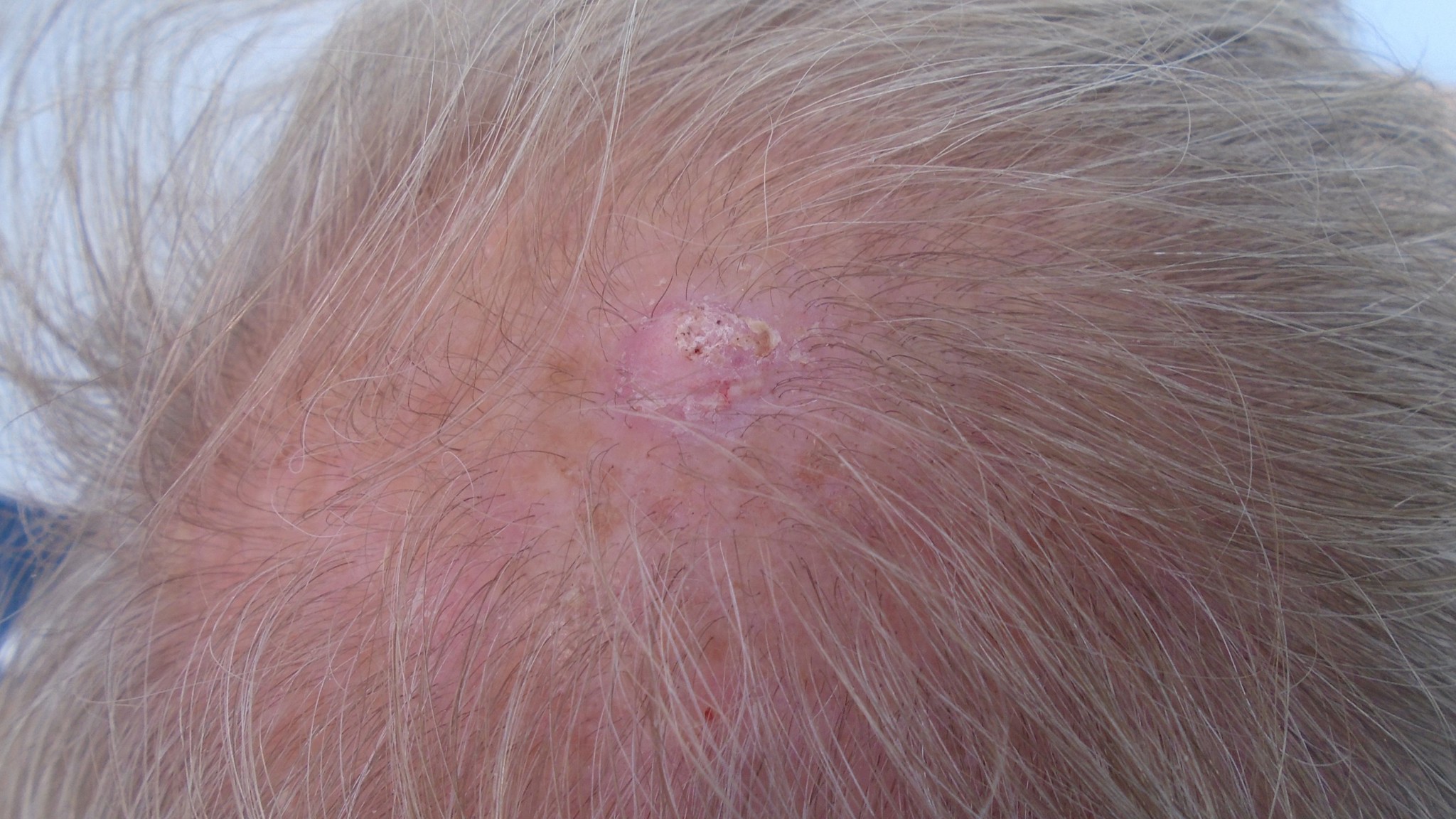 Ung thư da đầu: Nguyên nhân, triệu chứng, cách điều trị và phòng ngừa