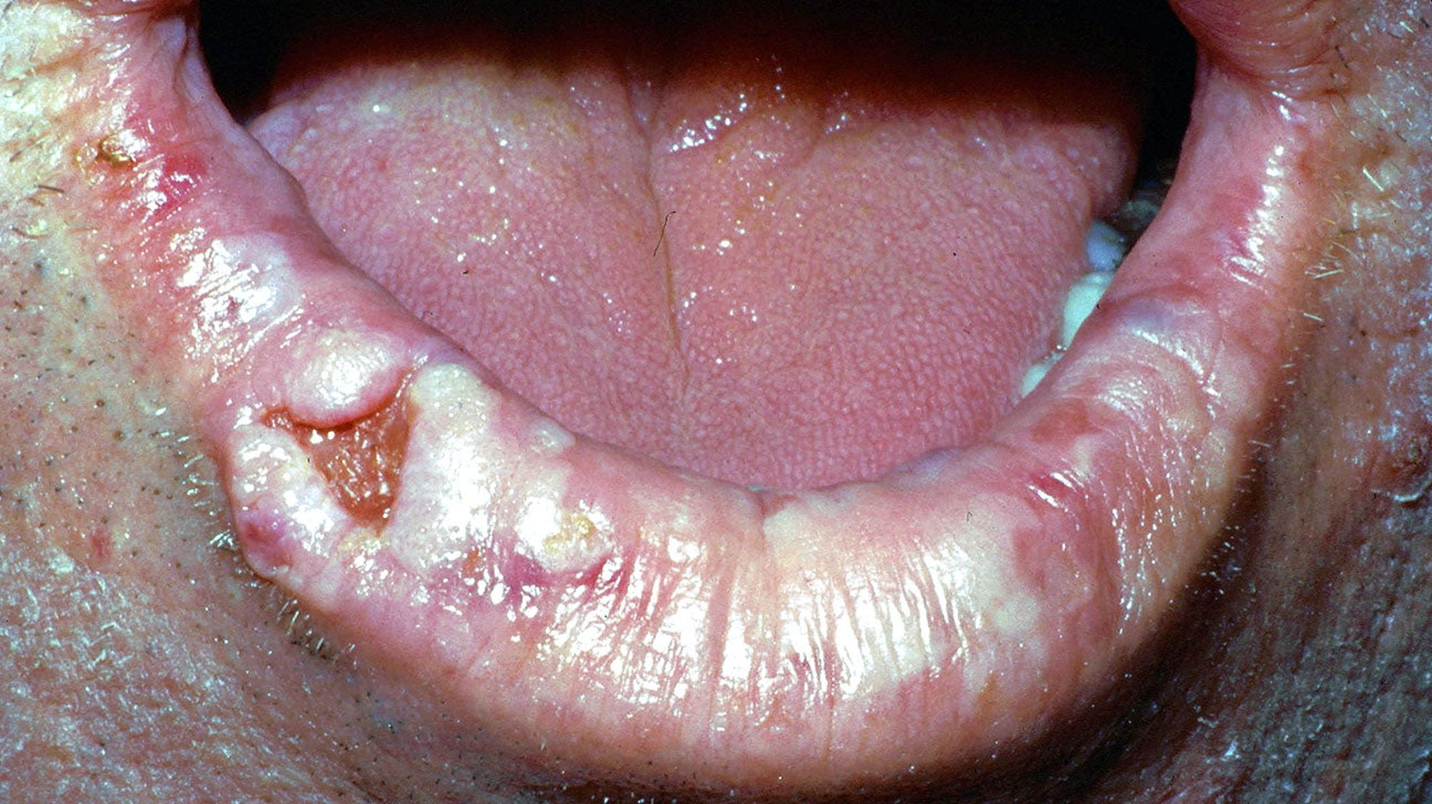 Ung thư môi: Nguyên nhân, triệu chứng và phương pháp điều trị