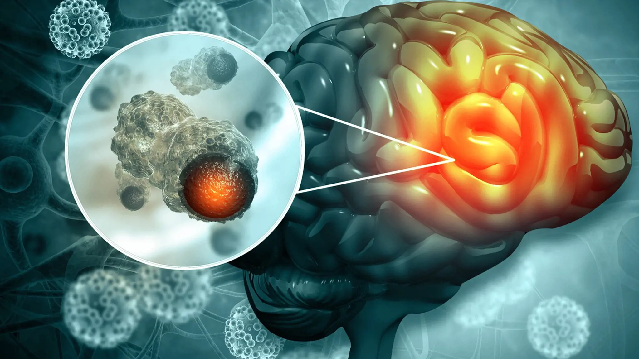 U tế bào thần kinh đệm ít nhánh là gì? Nguyên nhân, triệu chứng và cách điều trị