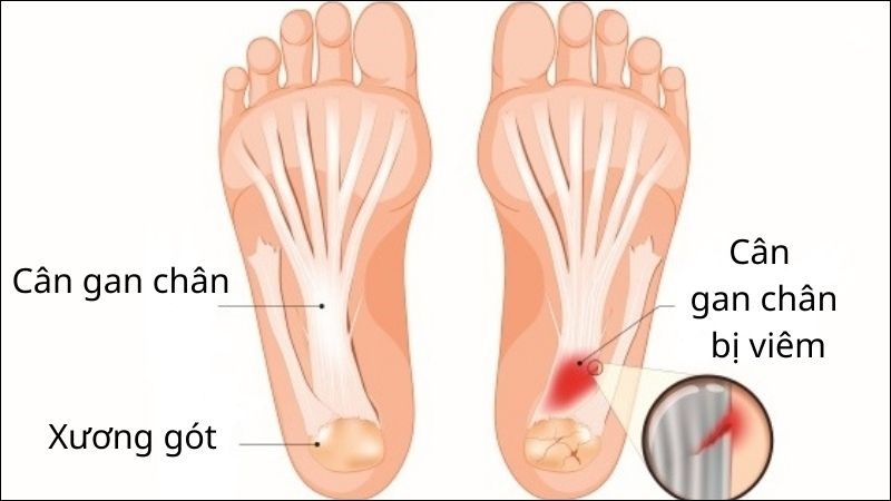 Viêm cân gan chân: Nguyên nhân, triệu chứng và điều trị