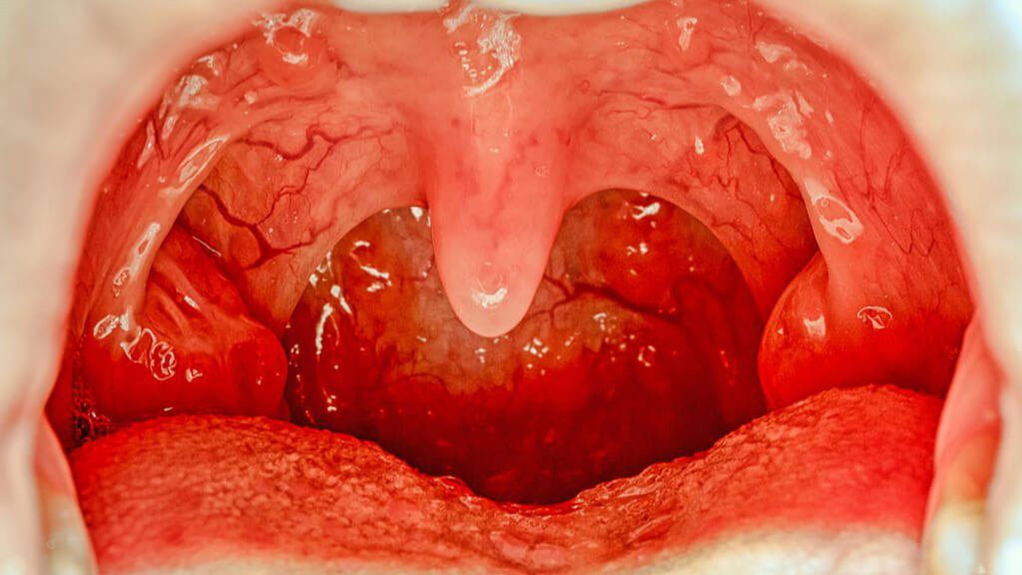 Viêm lưỡi gà là gì? Bệnh có nguy hiểm hay không?