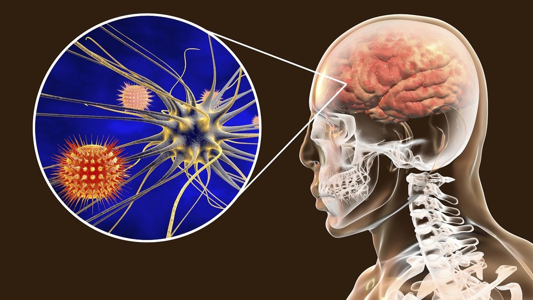 Viêm màng não mủ là bệnh lý gì? Viêm màng não mủ có để lại di chứng gì không?