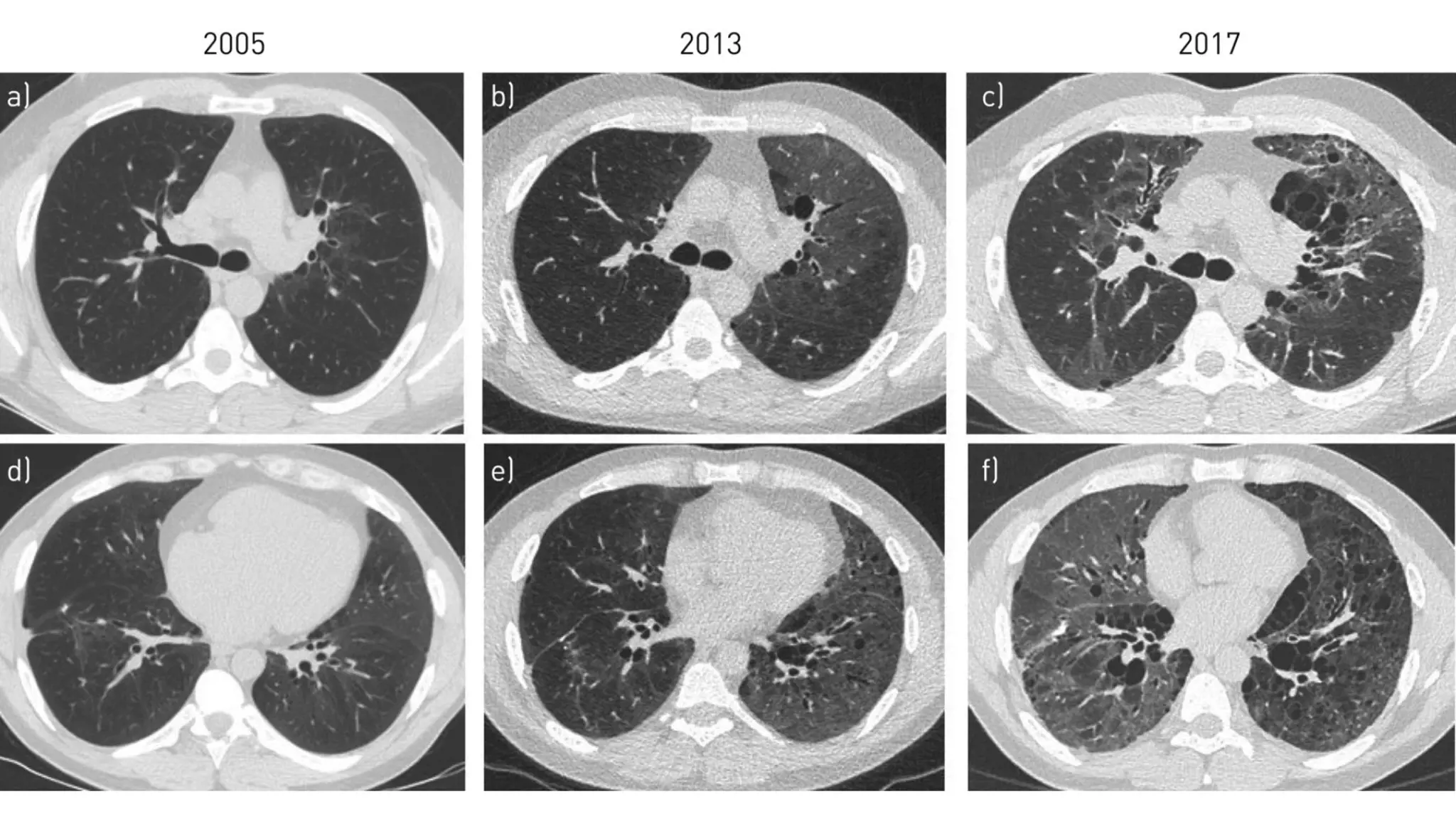 Viêm phổi kẽ tróc vảy là gì? Nguyên nhân và cách điều trị viêm phổi kẽ tróc vảy