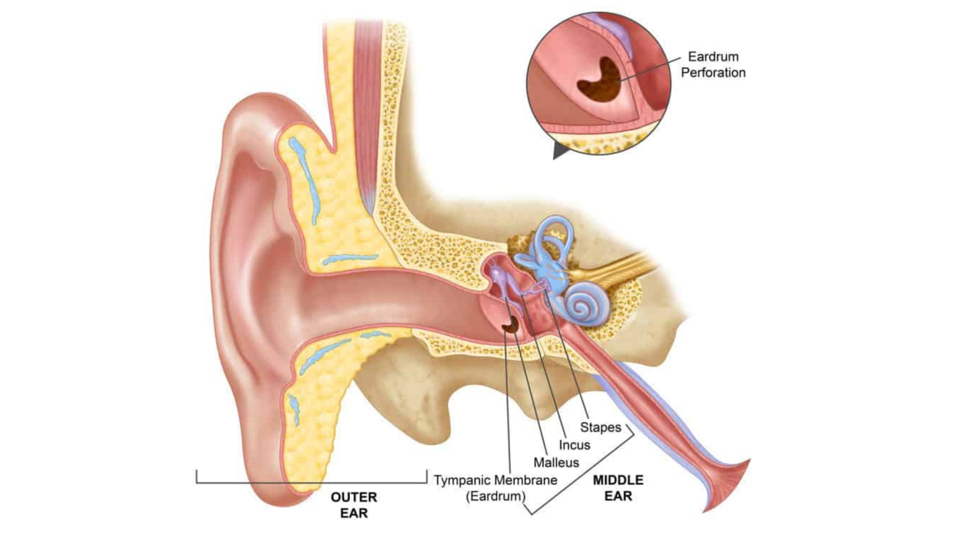 Viêm tai giữa thủng màng nhĩ là gì? Những vấn đề cần biết về viêm tai giữa thủng màng nhĩ